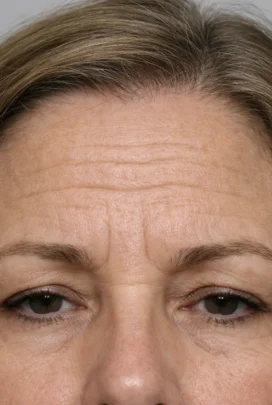 نکات قبل از لیفت پیشانی