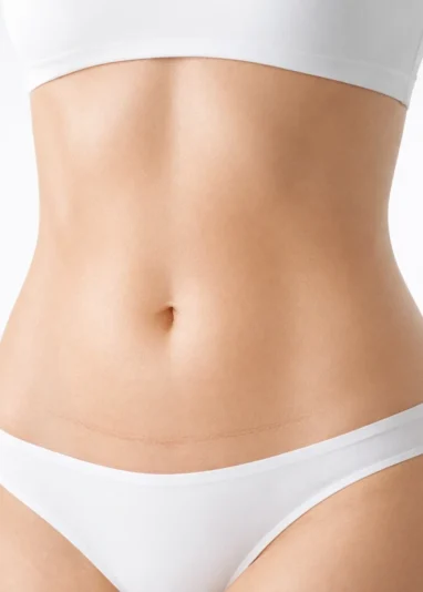 شکم صاف و متناسب پس از لیفت شکم با فرم طبیعی