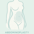 ابدومینوپلاستی
